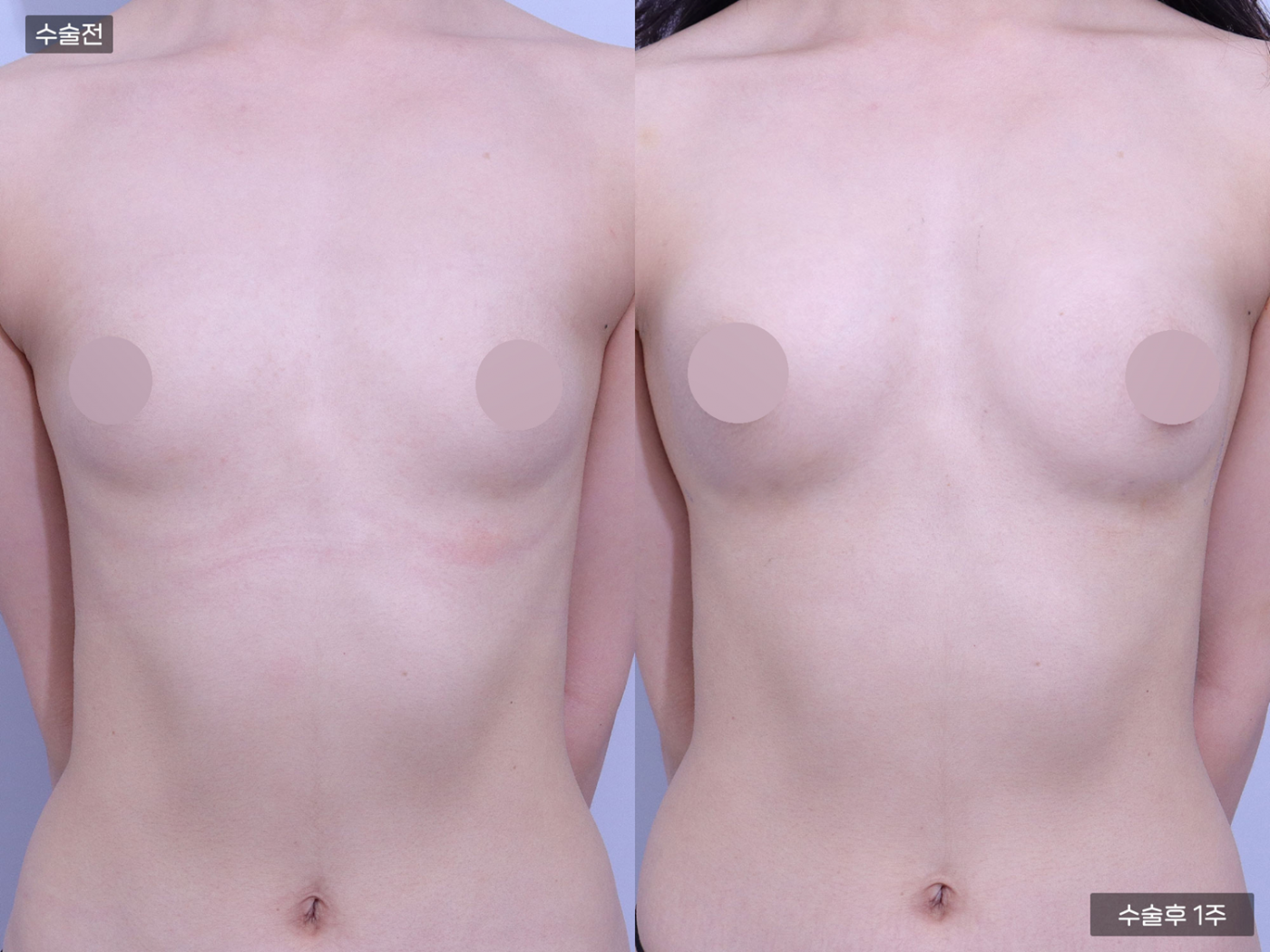 가슴성형 [가슴지방이식(150CC + 150CC)]