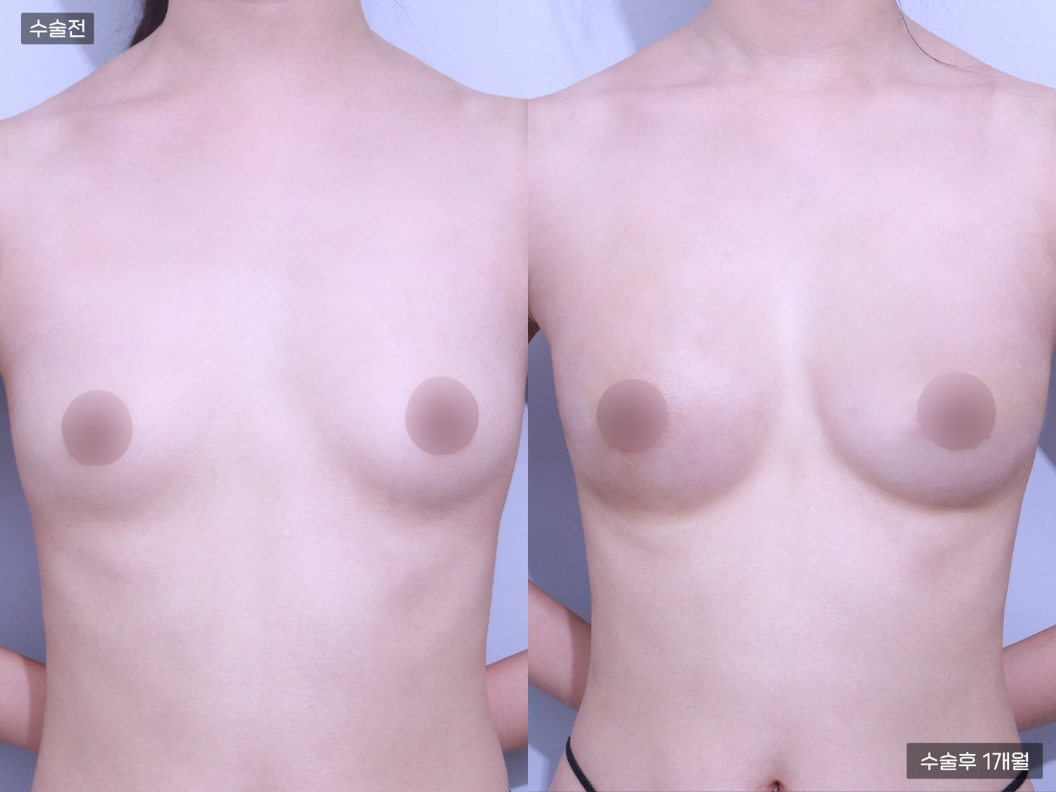 PRP가슴지방이식 (250cc + 250cc)