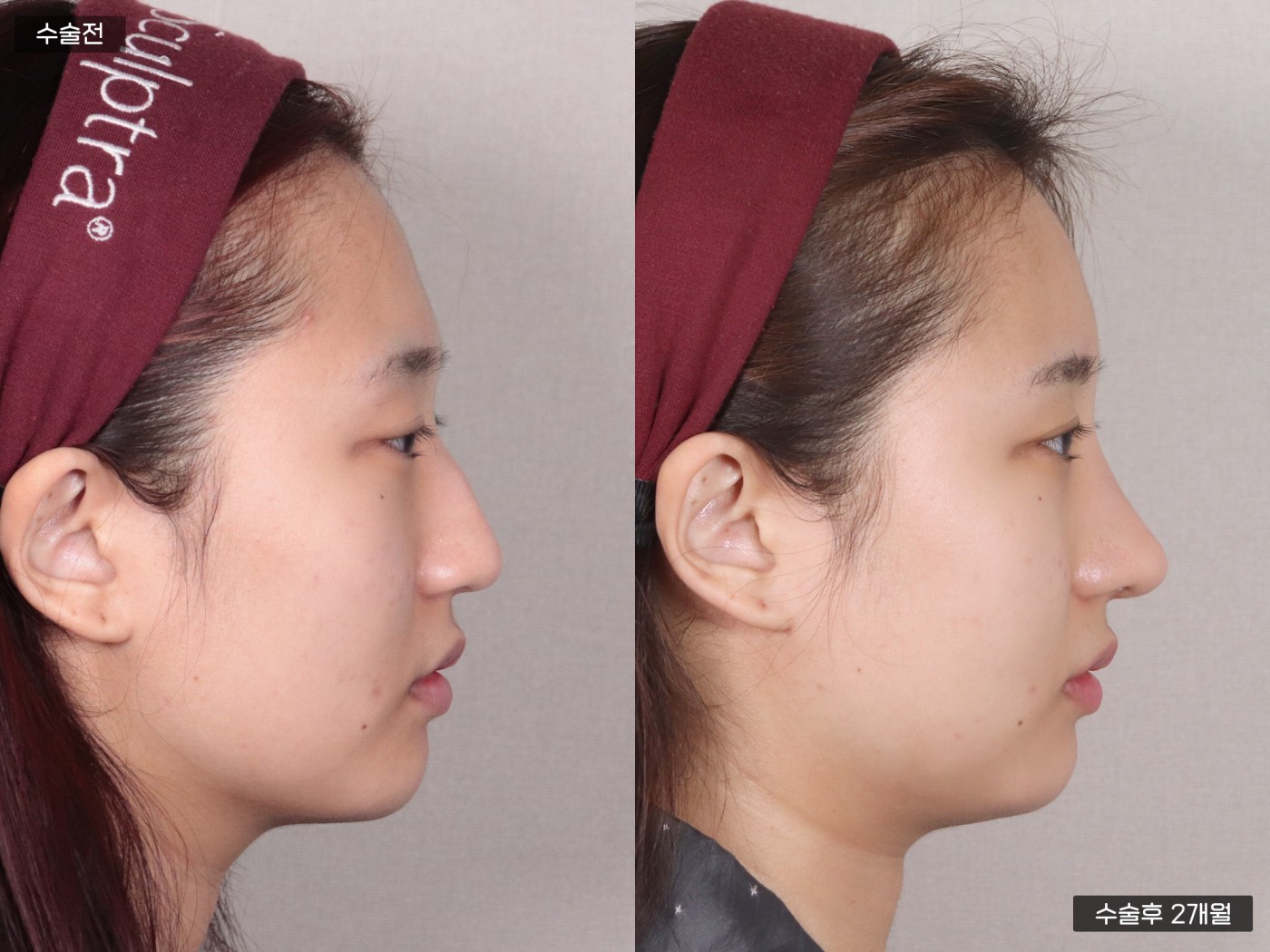 기능코(코끝 비중격) + 매부리 교정 + 이마 지방이식