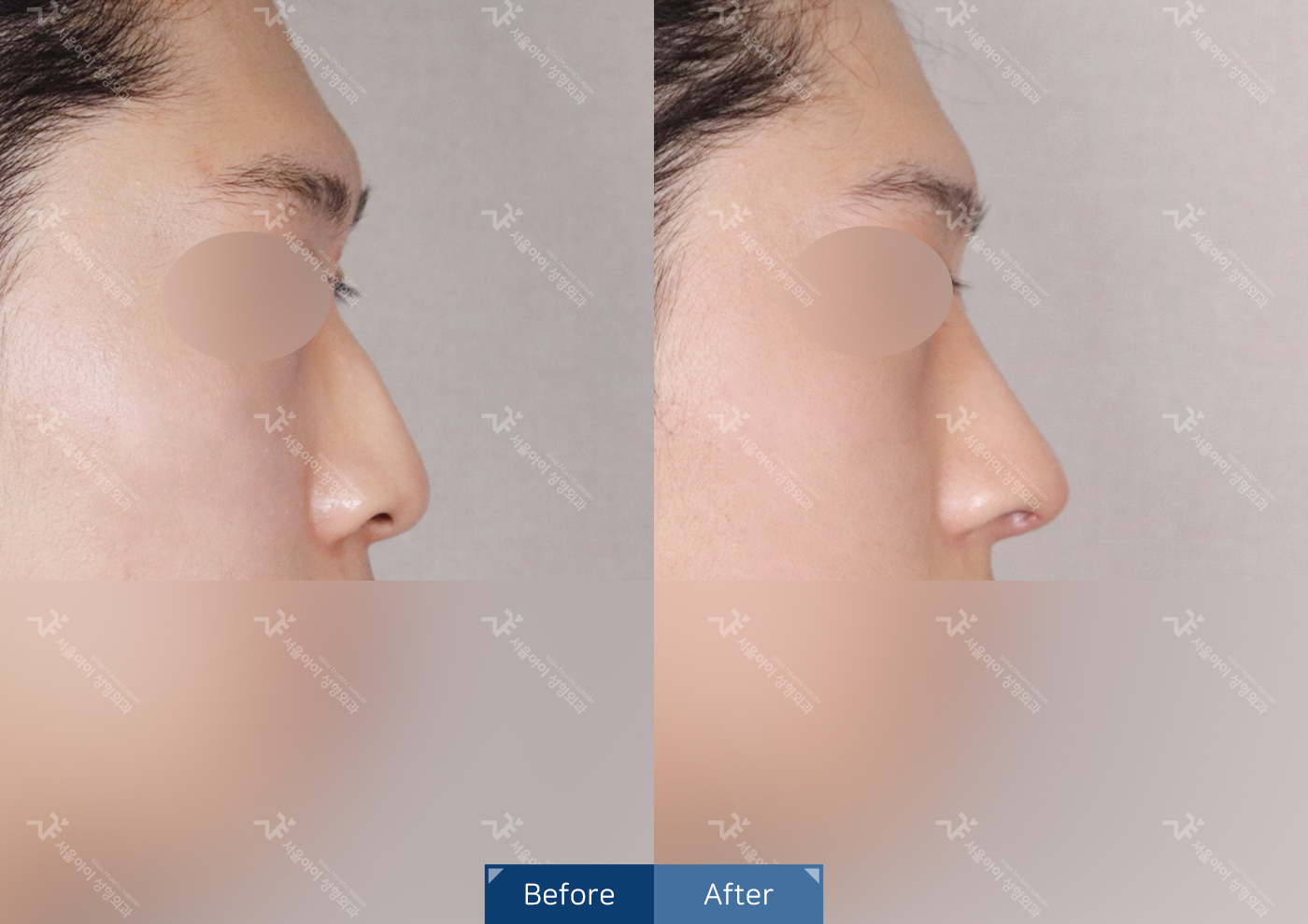 코성형 [기능2종+미용코]