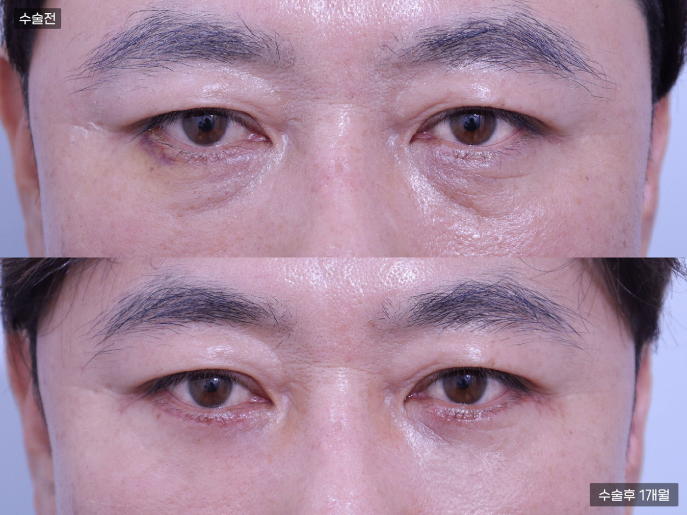 눈성형 [하안검]