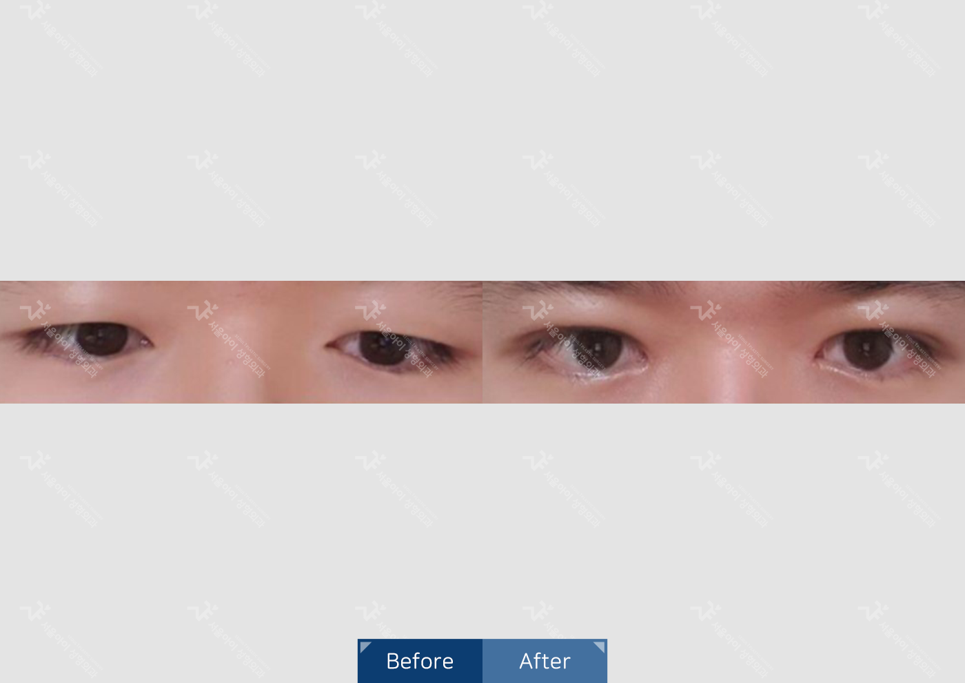 눈성형 [자연유착 쌍꺼풀 + 앞트임]