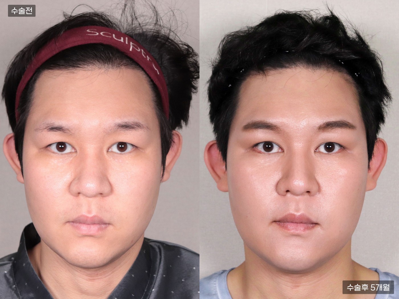 모발이식[비절개 모발이식(3000모)]