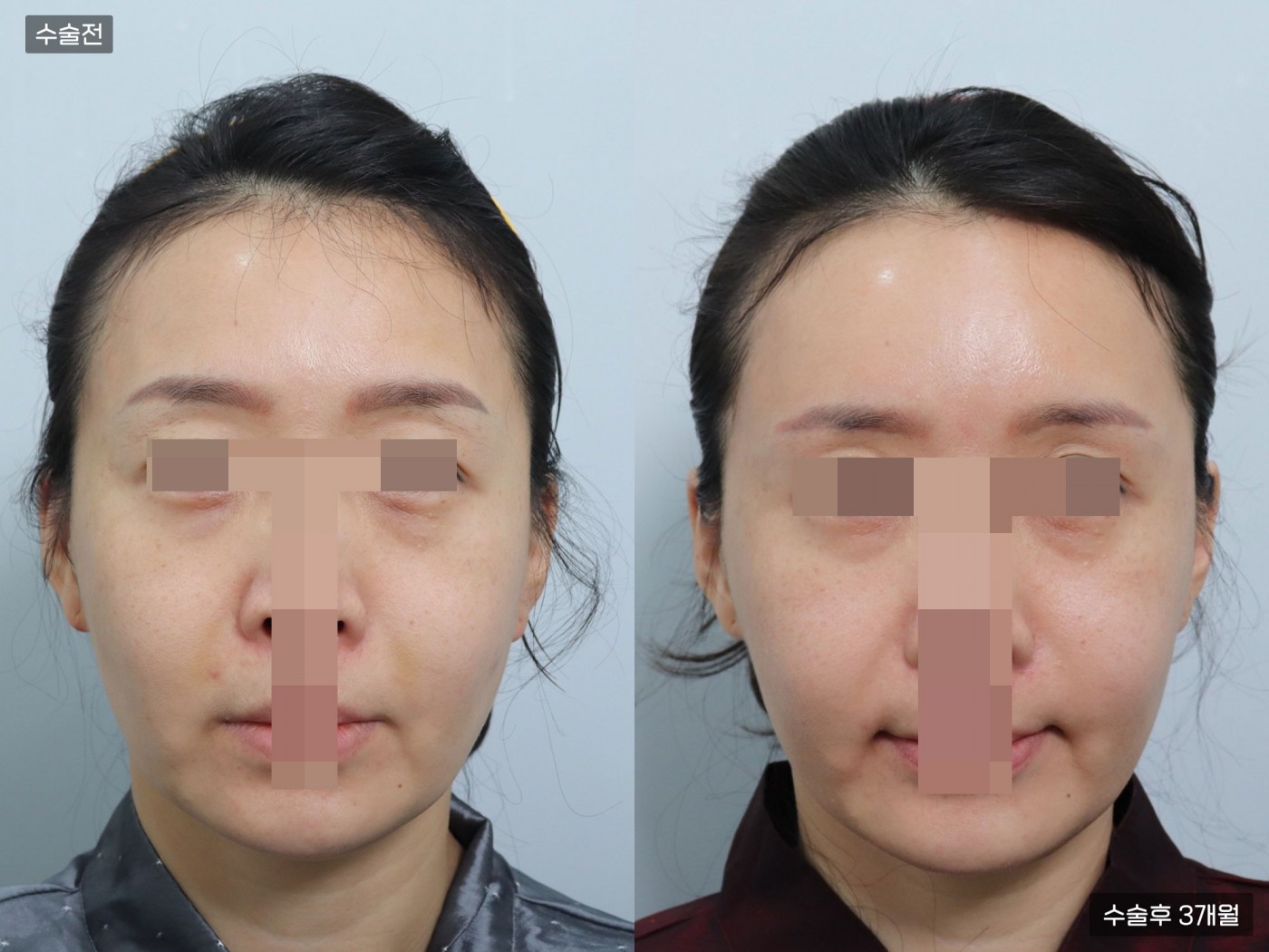 지방이식 [풀페이스]