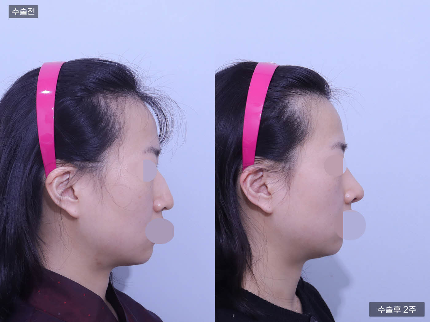 코끝교정 + 매부리코 + 콧볼축소