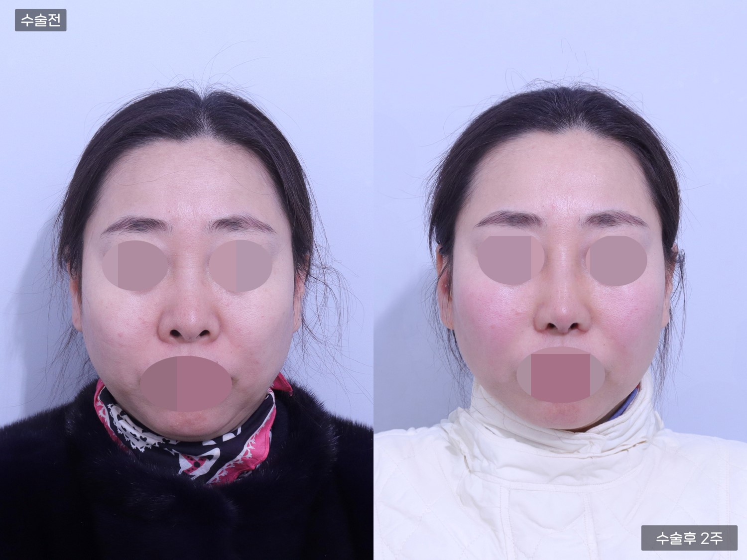 코끝(비중격) + 복코 + 콧볼축소 + 비공내리기