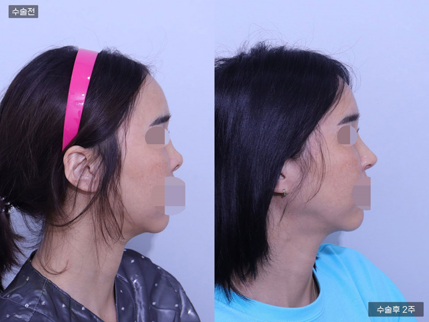 코끝 + 복코교정 + 비공내리기