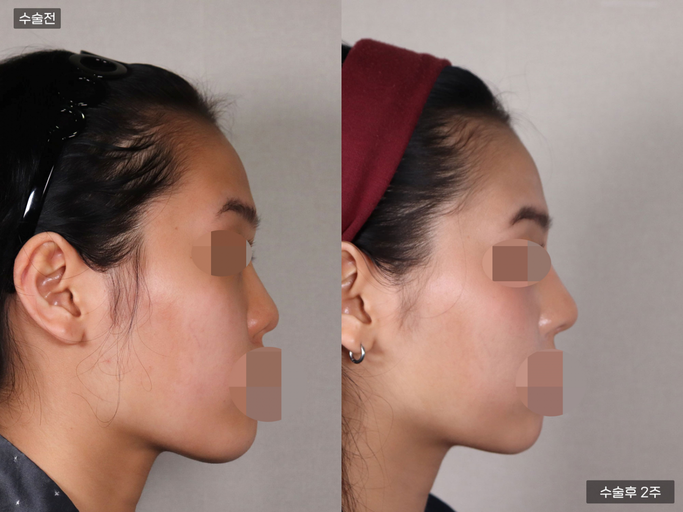 짧은코 + 복코 + 매부리코