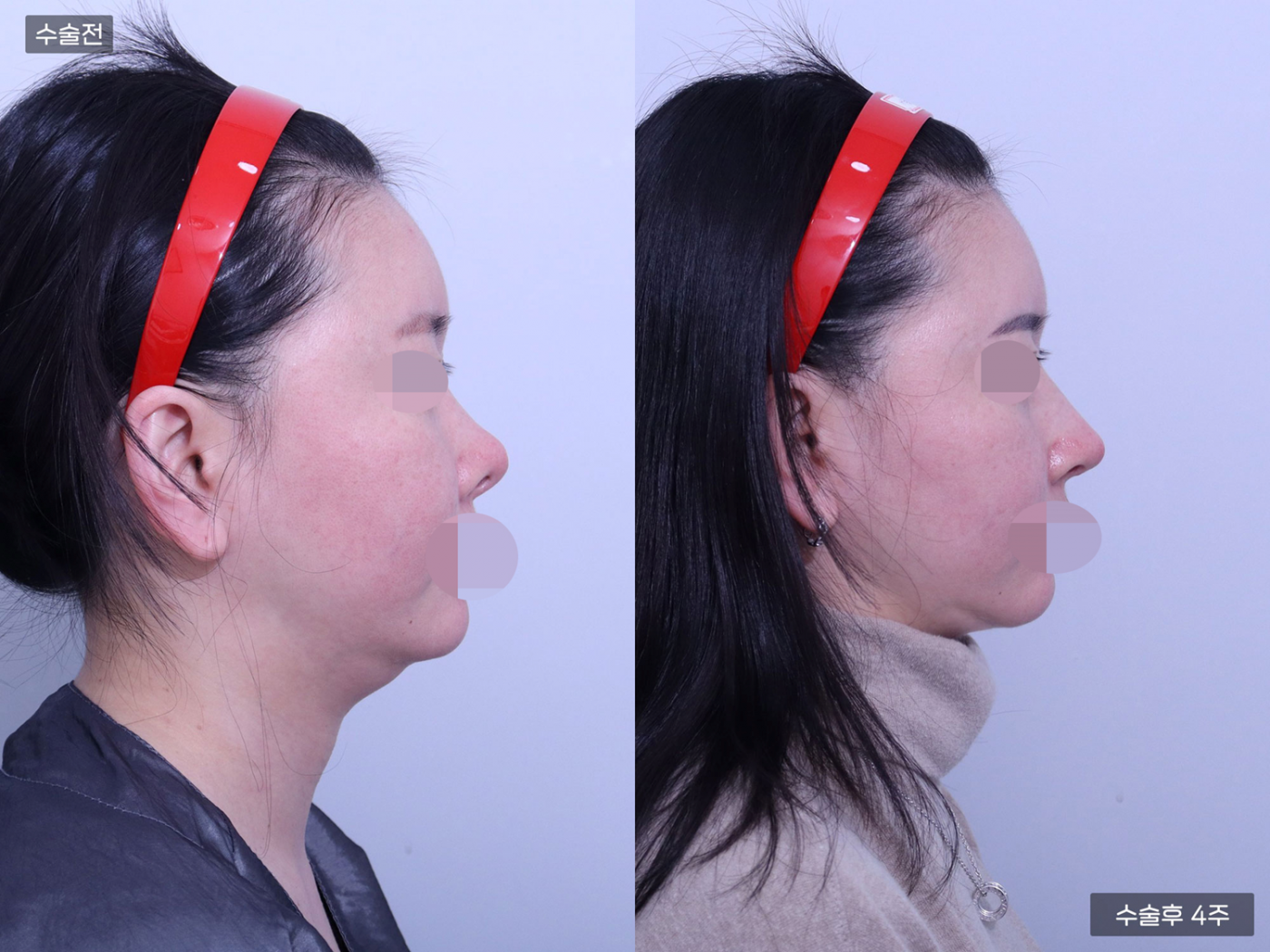 비공내리기 + 복코 + 매부리코 + 콧볼축소