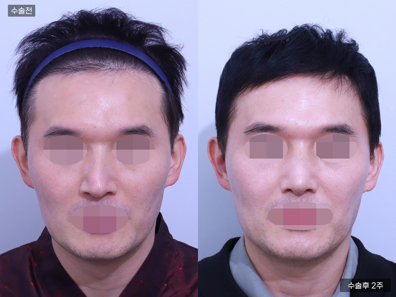 휜코 + 코끝 +  매부리코 