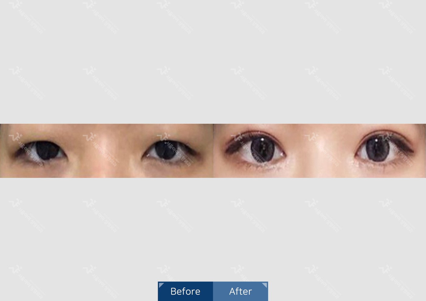 눈성형 [자연유착 쌍꺼풀 + 앞트임]