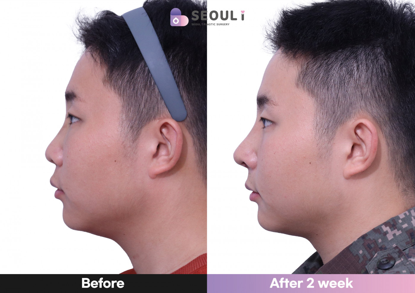 코끝(비중격) + 콧대 + 복코 교정술 + 매부리 + 교정코뼈골절수술(늑연골)