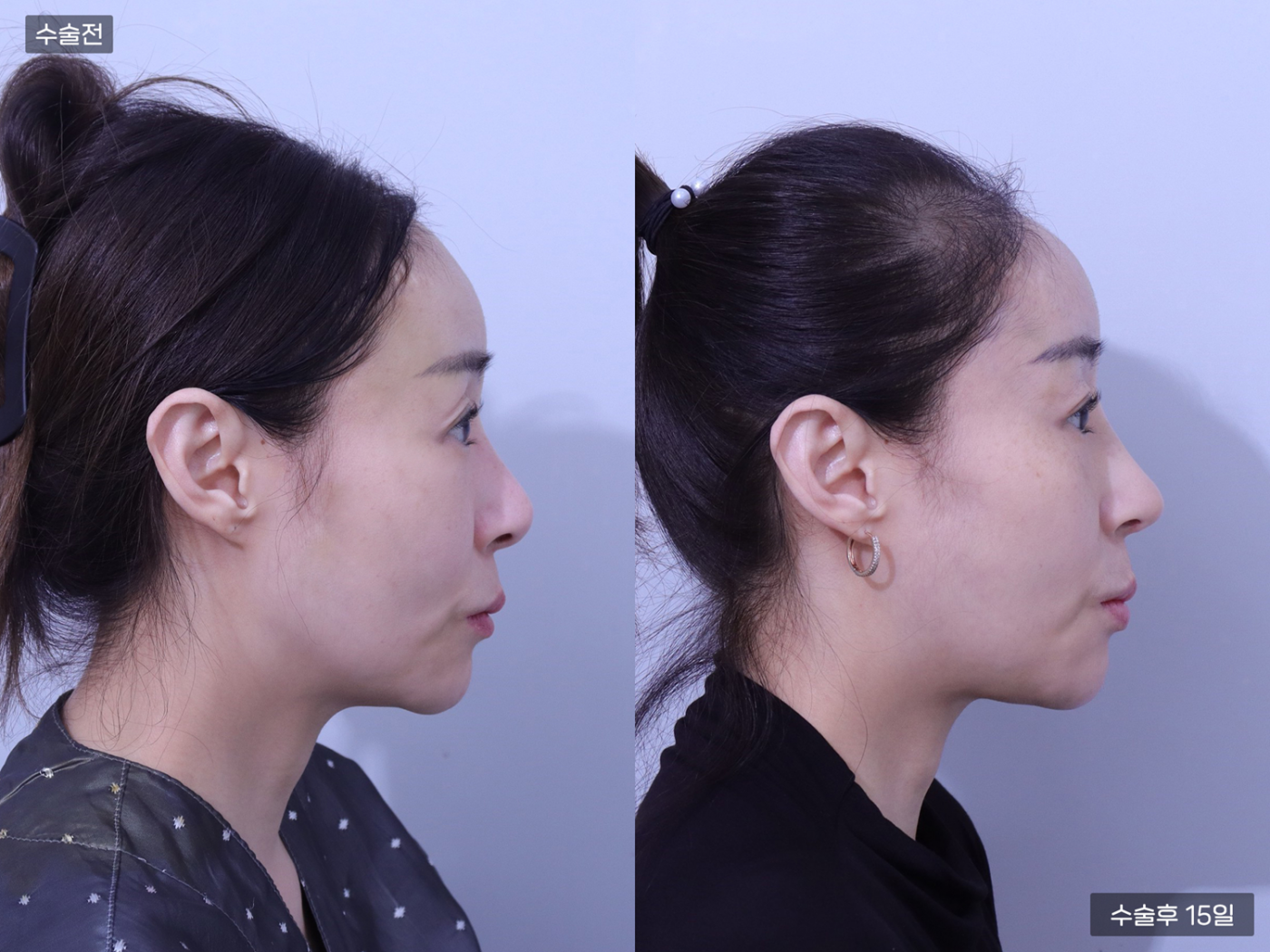 코재수술 + 코끝