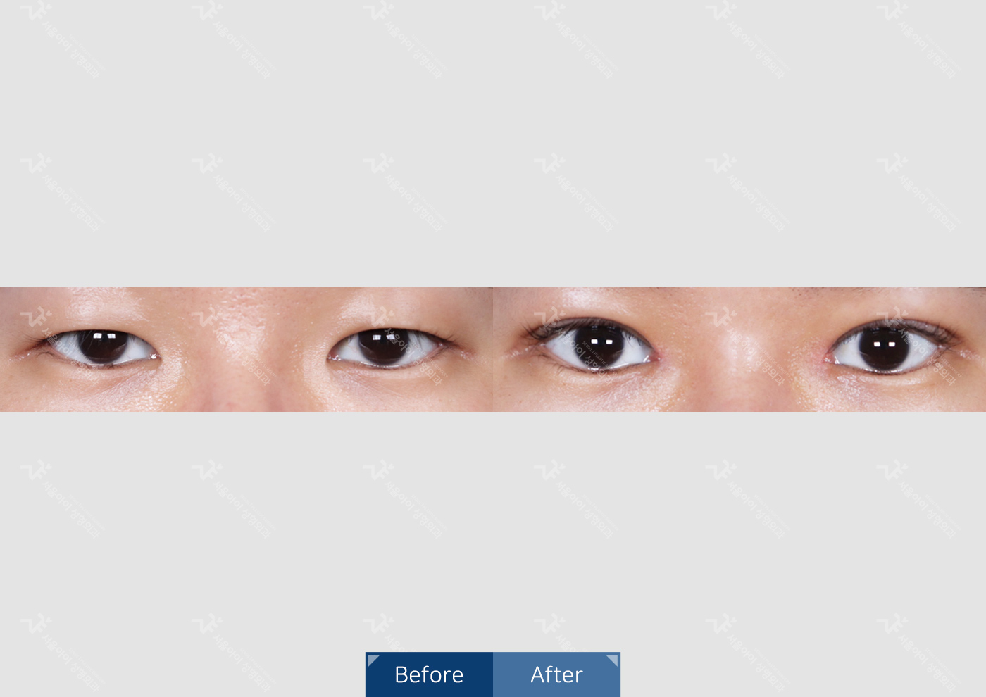 눈성형 [자연유착 쌍꺼풀 + 눈매교정 + 앞트임]