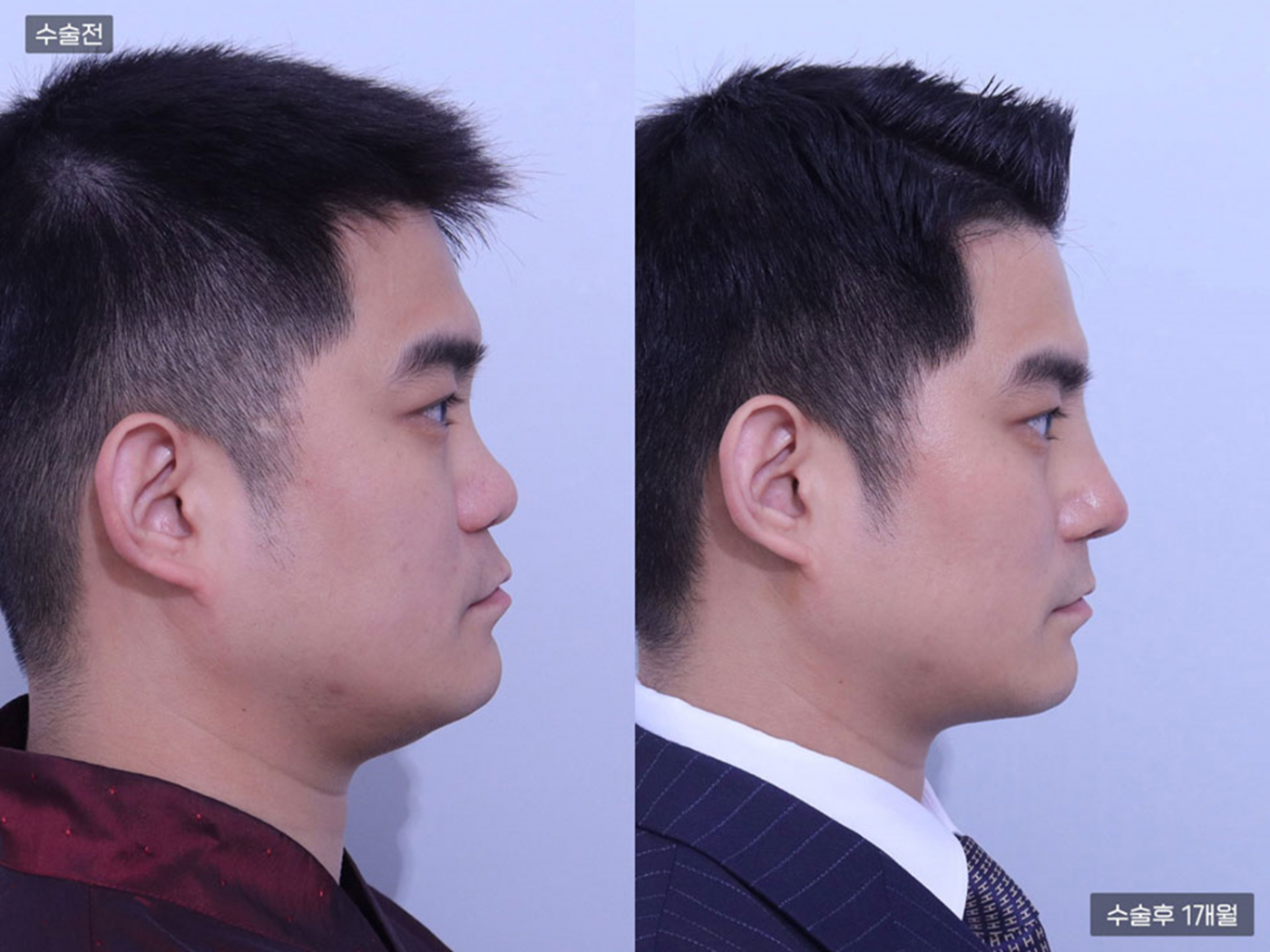 복코 + 매부리코 + 콧볼축소 + 코끝(비중격)