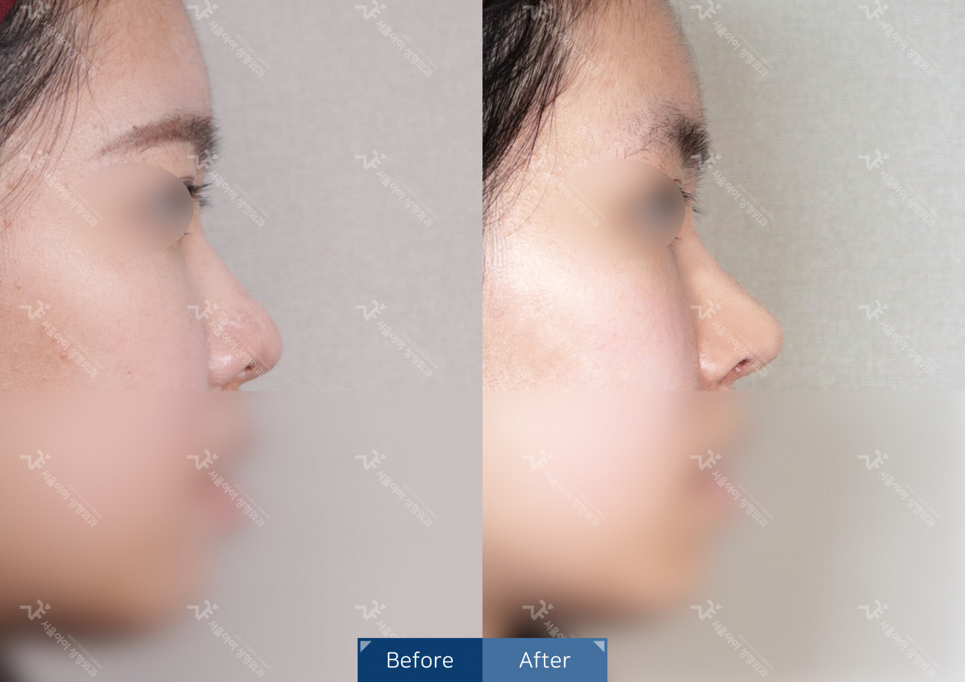 코성형 [코끝조각술+귀연골]