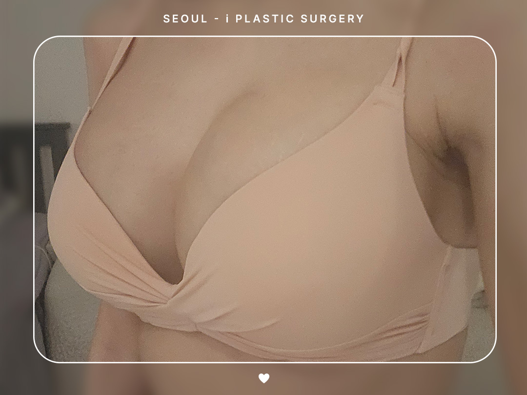 #가슴 #지방이식 #줄기세포가슴지방이식