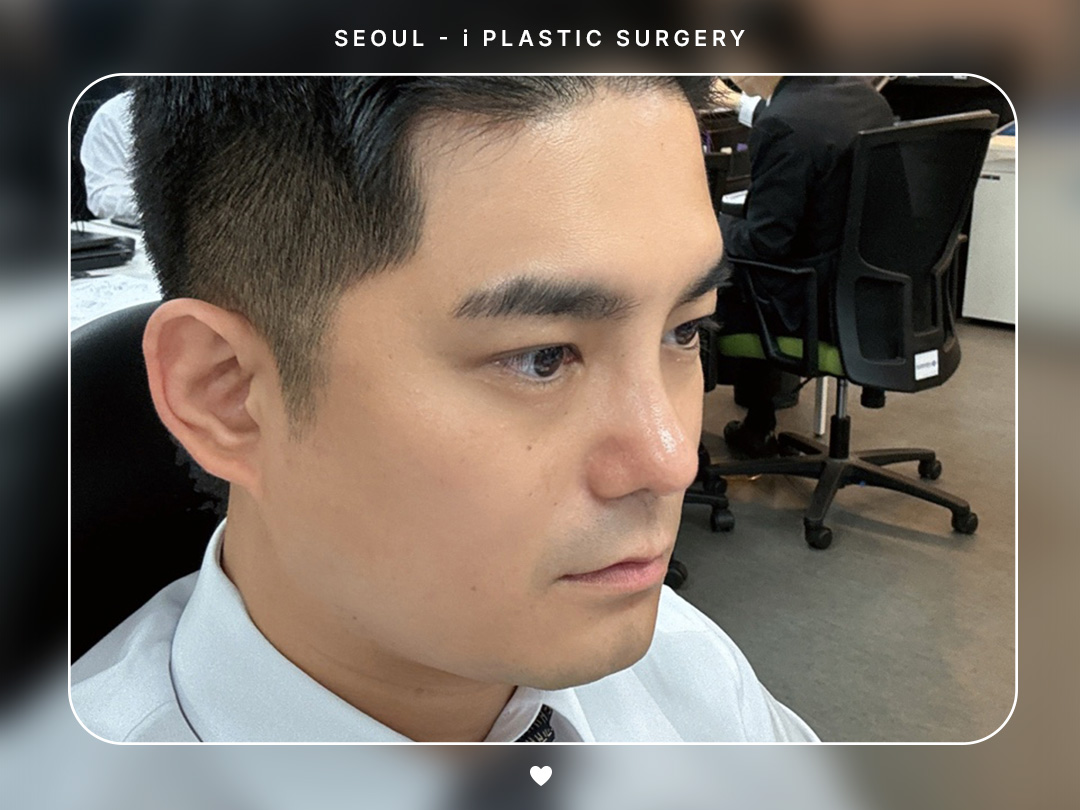 #미용코 #복코 #매부리코교정