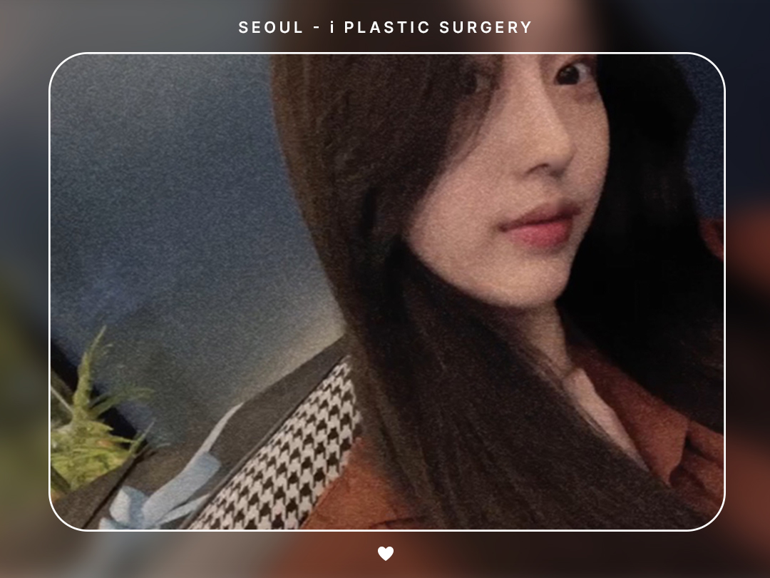 #미용코 #복코 #매부리코교정