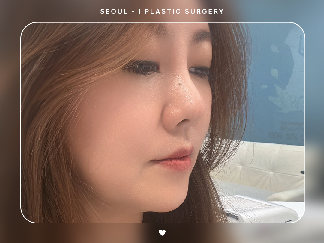 #미용코 #복코 #매부리코교정