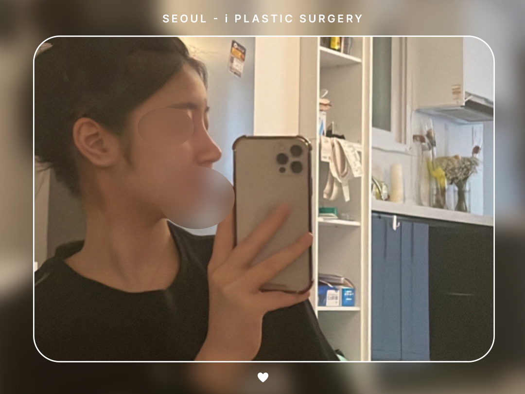 #미용코 #복코 #매부리코교정