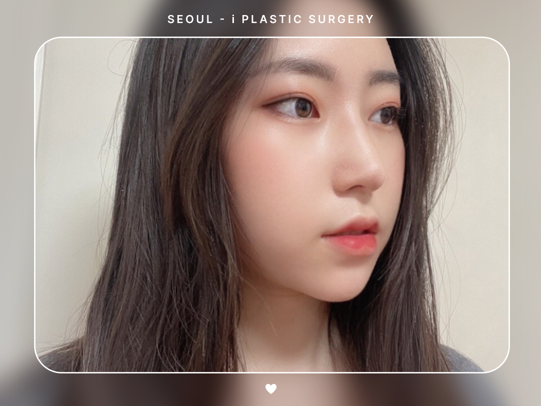 #미용코 #복코 #매부리코교정