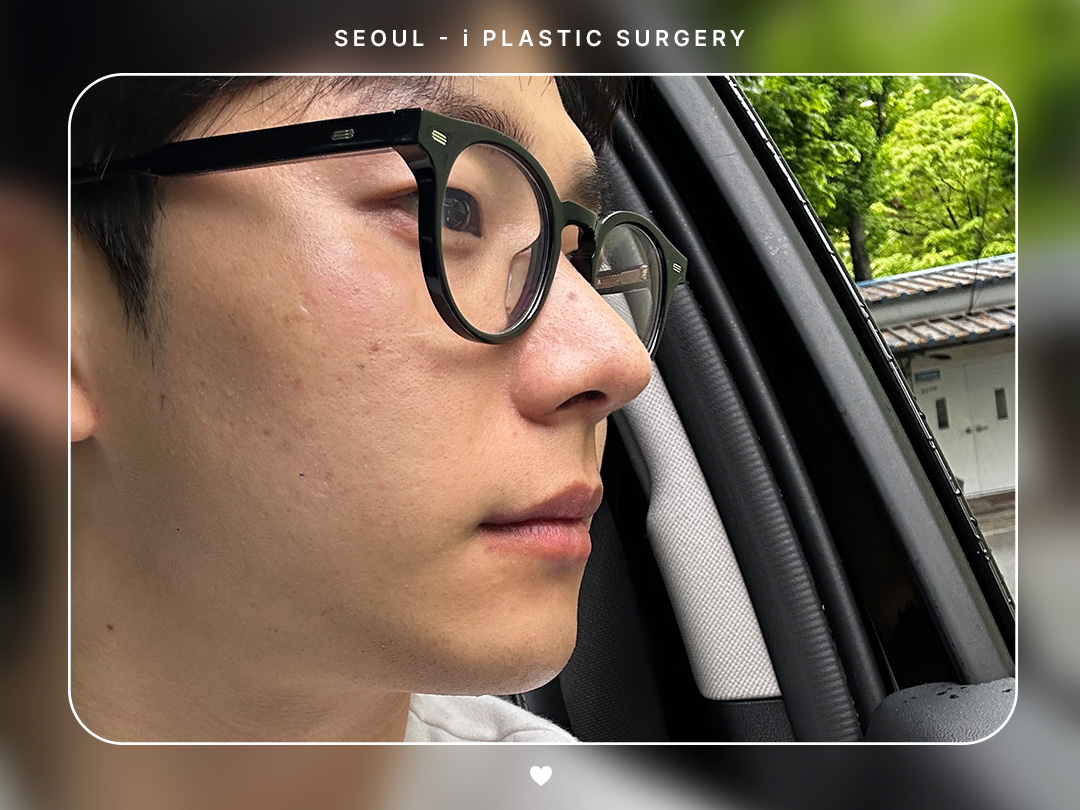 #미용코 #복코 #매부리코교정