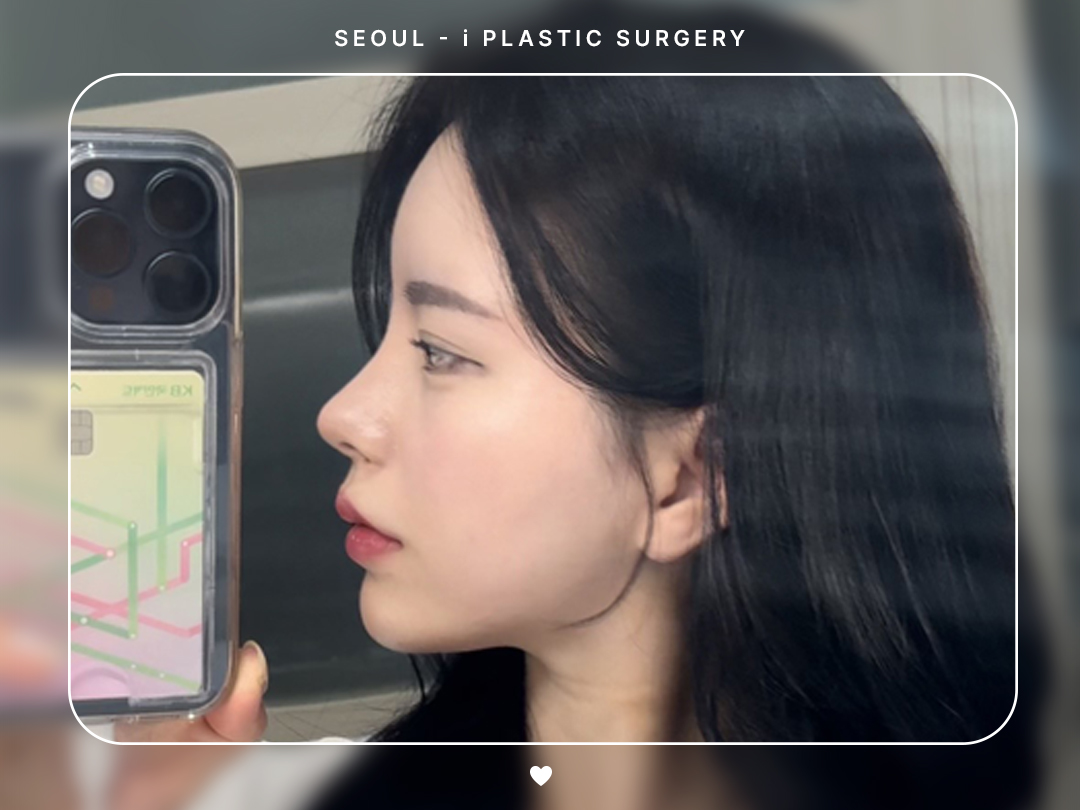 #코끝조각술 #복코교정 #매부리교정