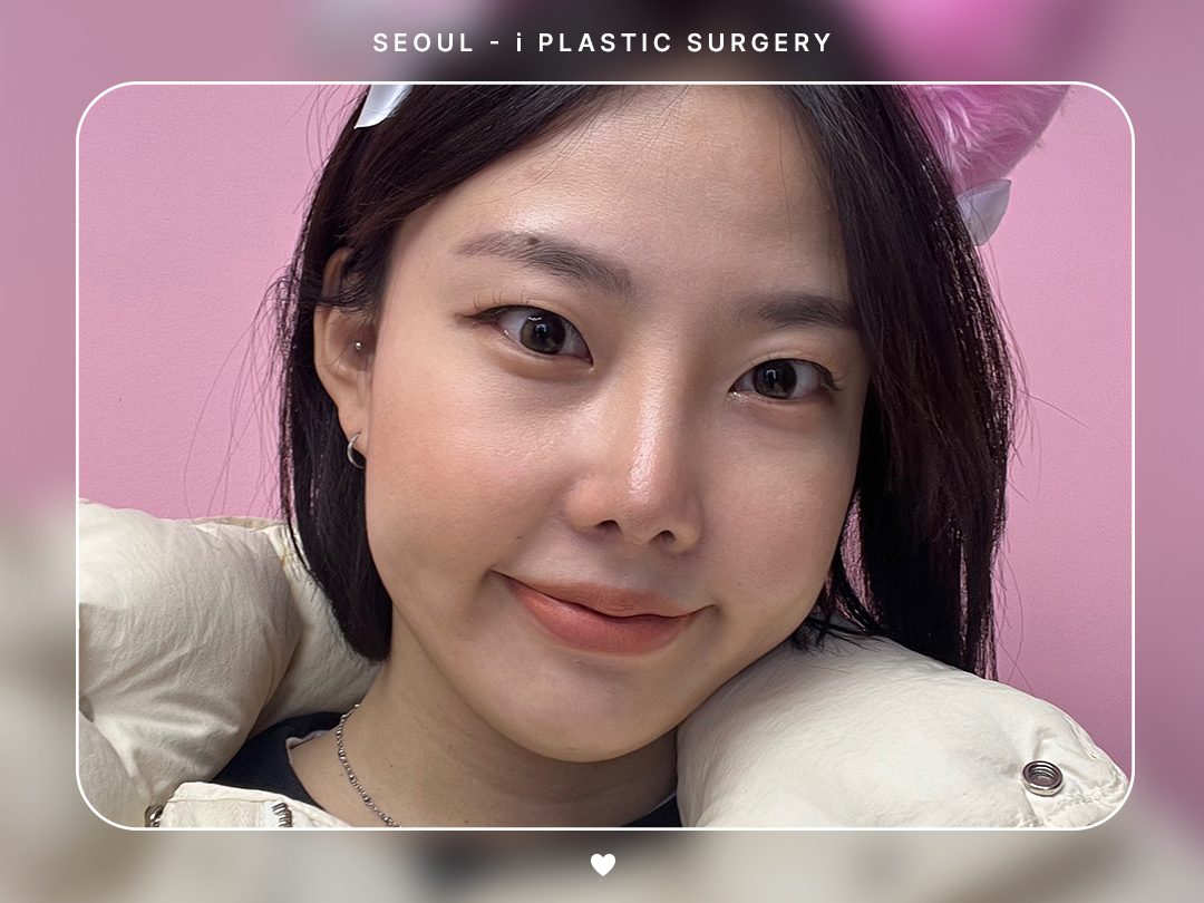 #미용코 #짧은코교정