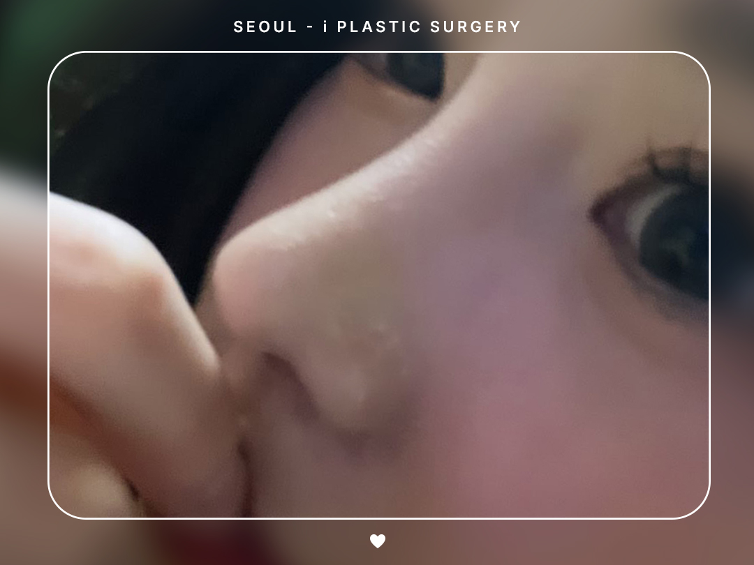 #미용코 #복코 #매부리코교정