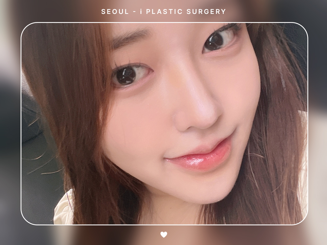 #미용코 #복코 #매부리코교정