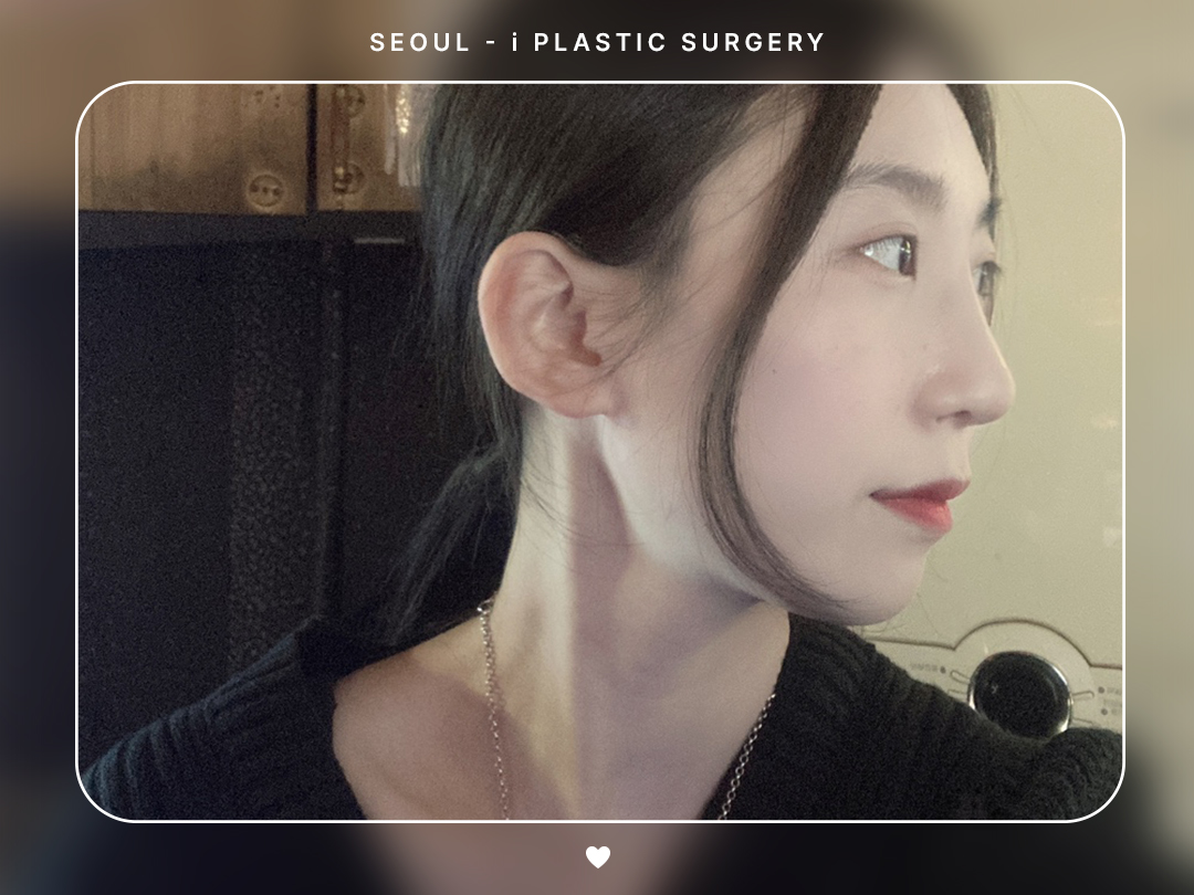 #미용코 #복코 #매부리코교정