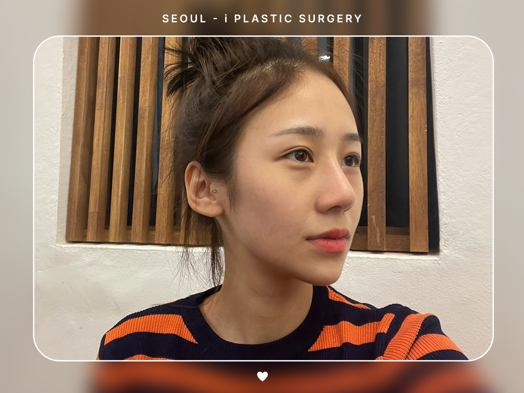 #미용코 #콧대 #코끝교정