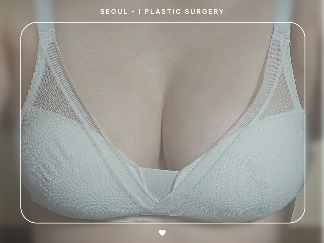 #가슴 #지방이식 #줄기세포가슴지방이식