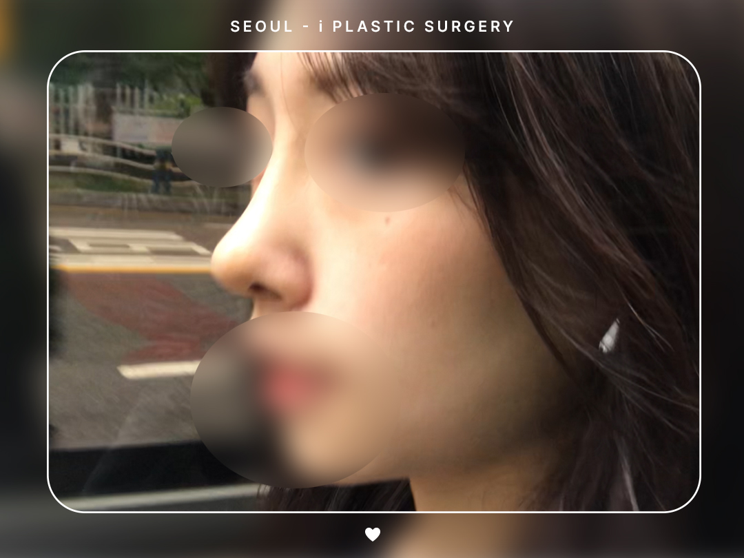 #미용코 #콧대 #매부리코교정