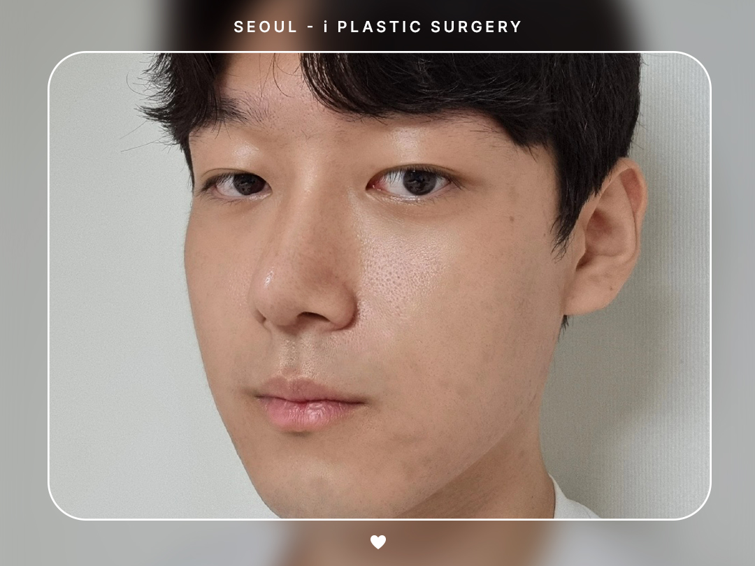 #미용코 #복코 #매부리코교정 #콧볼축소