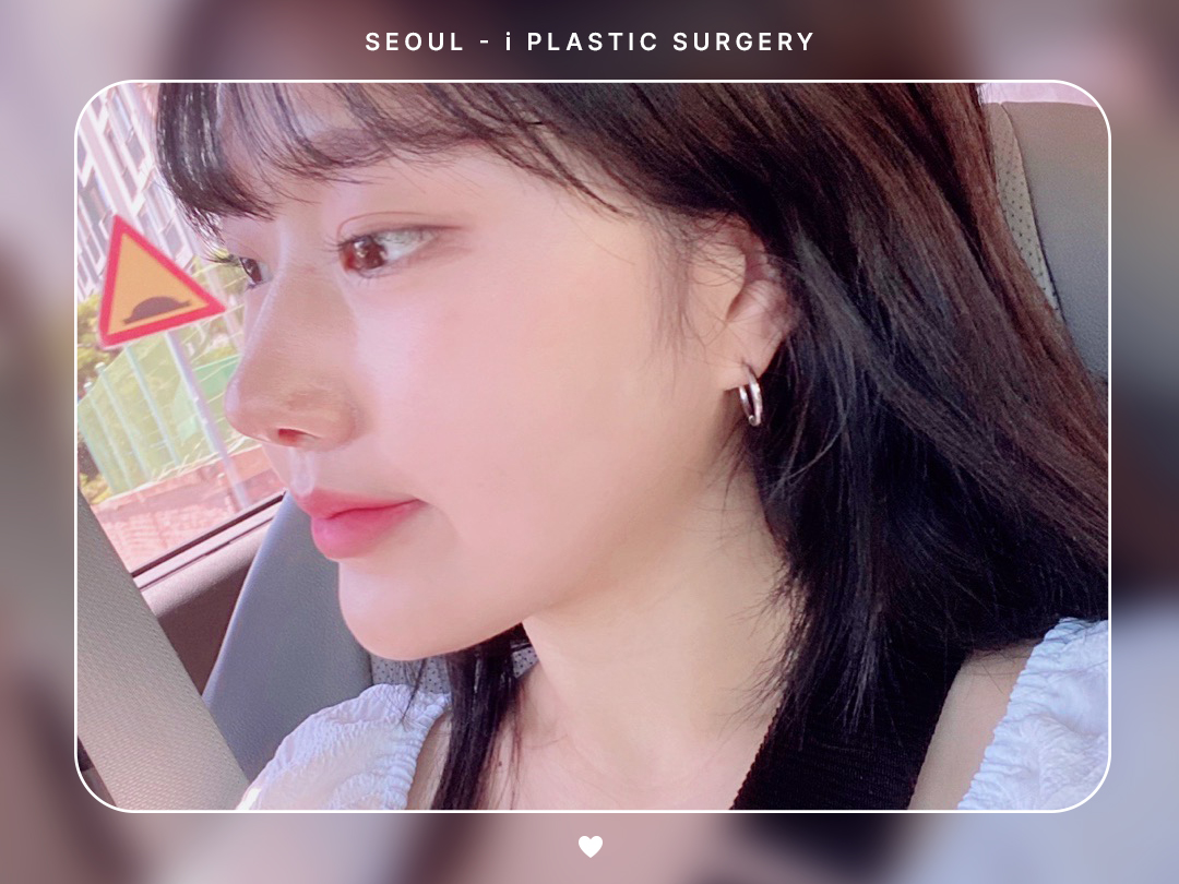 #미용코 #콧대 #매부리코교정