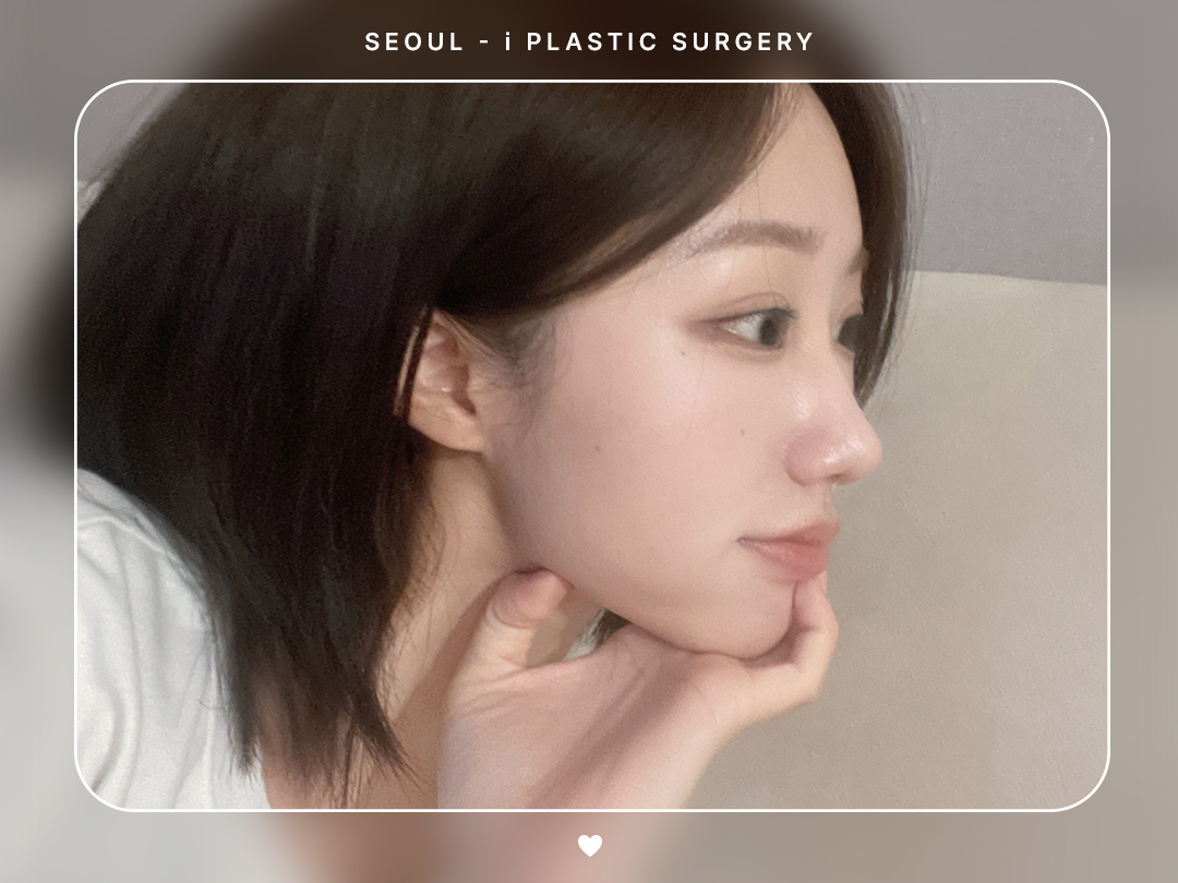 #미용코 #콧대 #매부리코교정