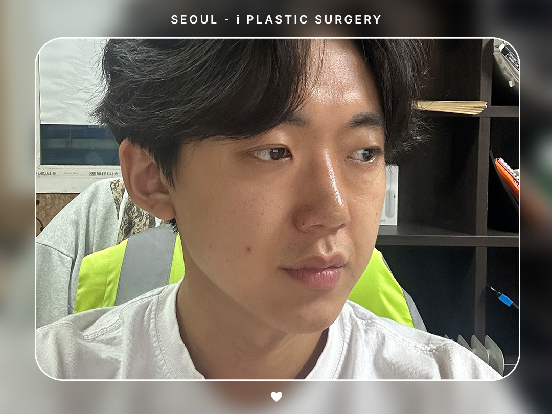 #미용코 #콧대 #코끝교정