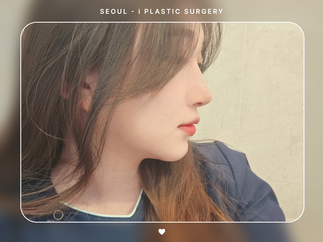 #미용코 #복코 #매부리코교정