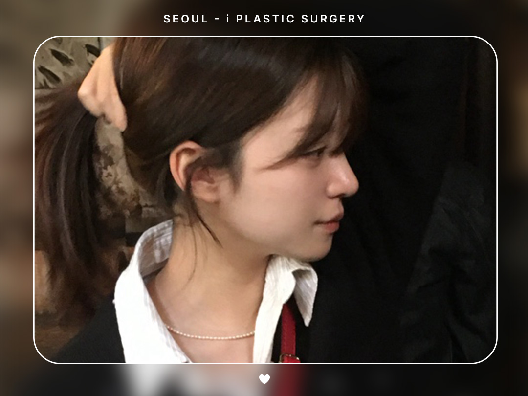 #미용코 #복코 #매부리코교정