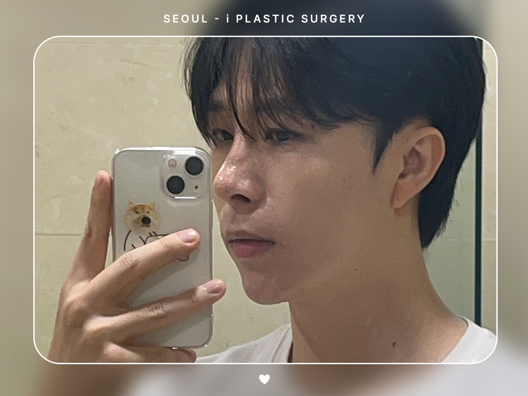 #자연유착 #눈매교정