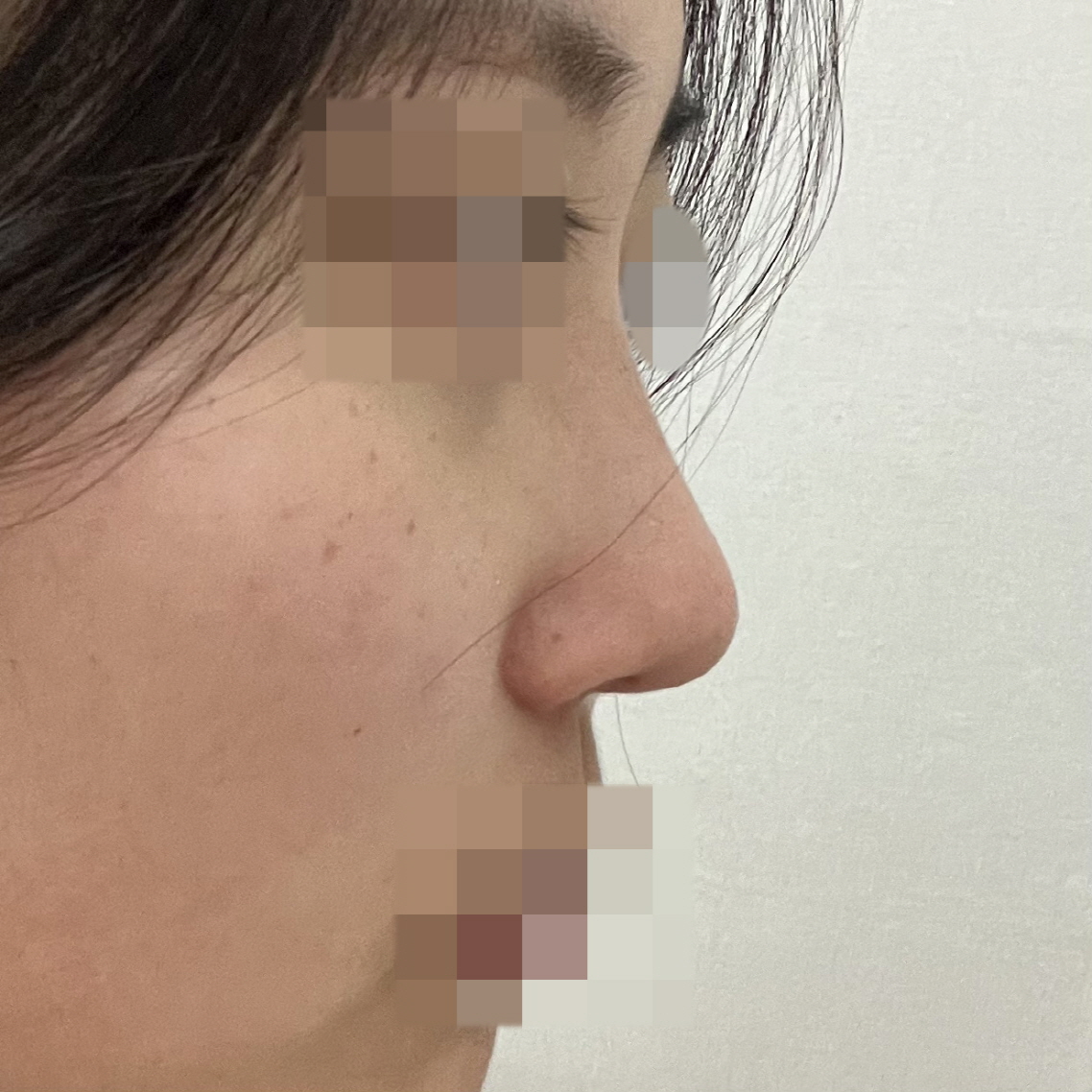 수술후기이미지