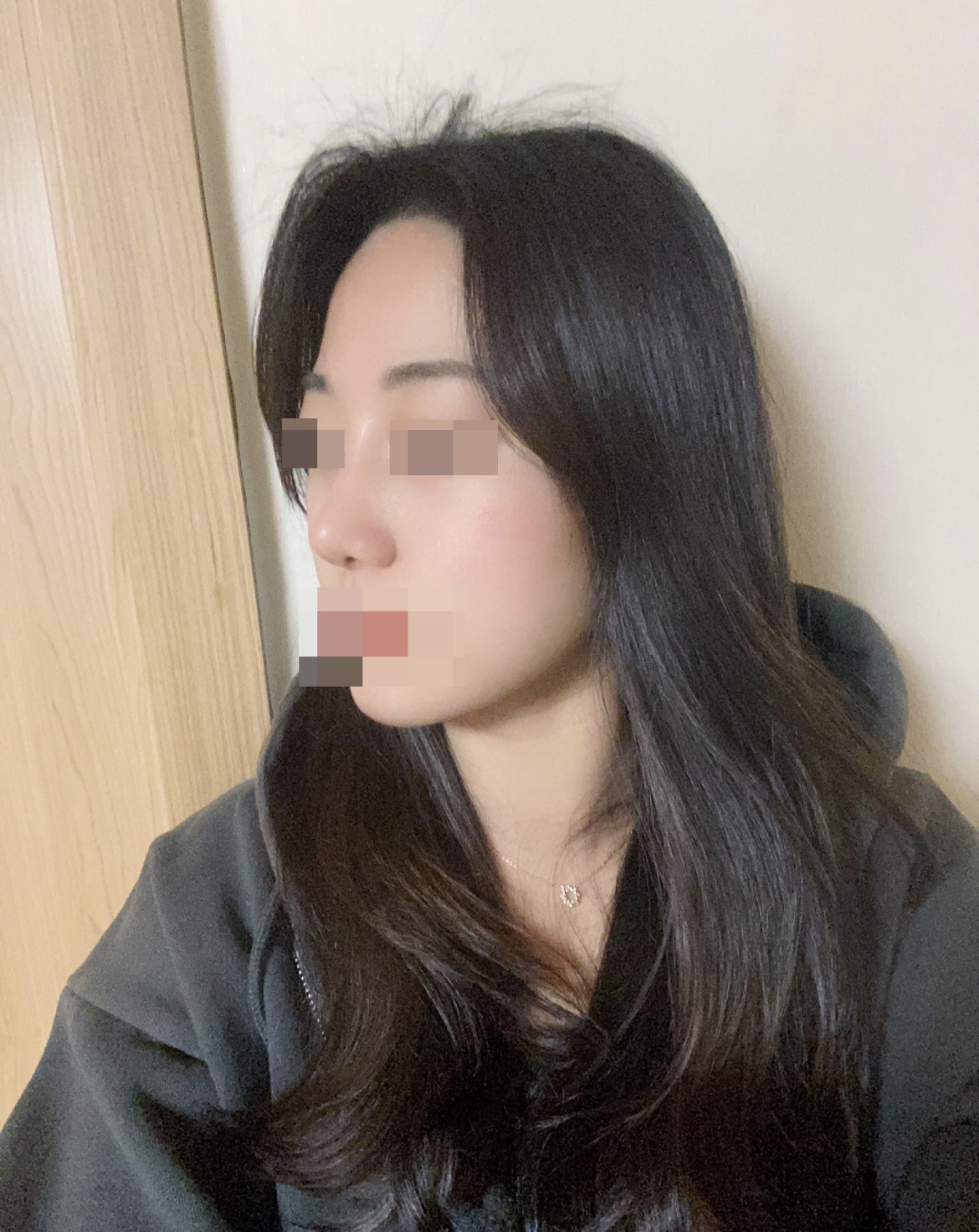 수술후기이미지