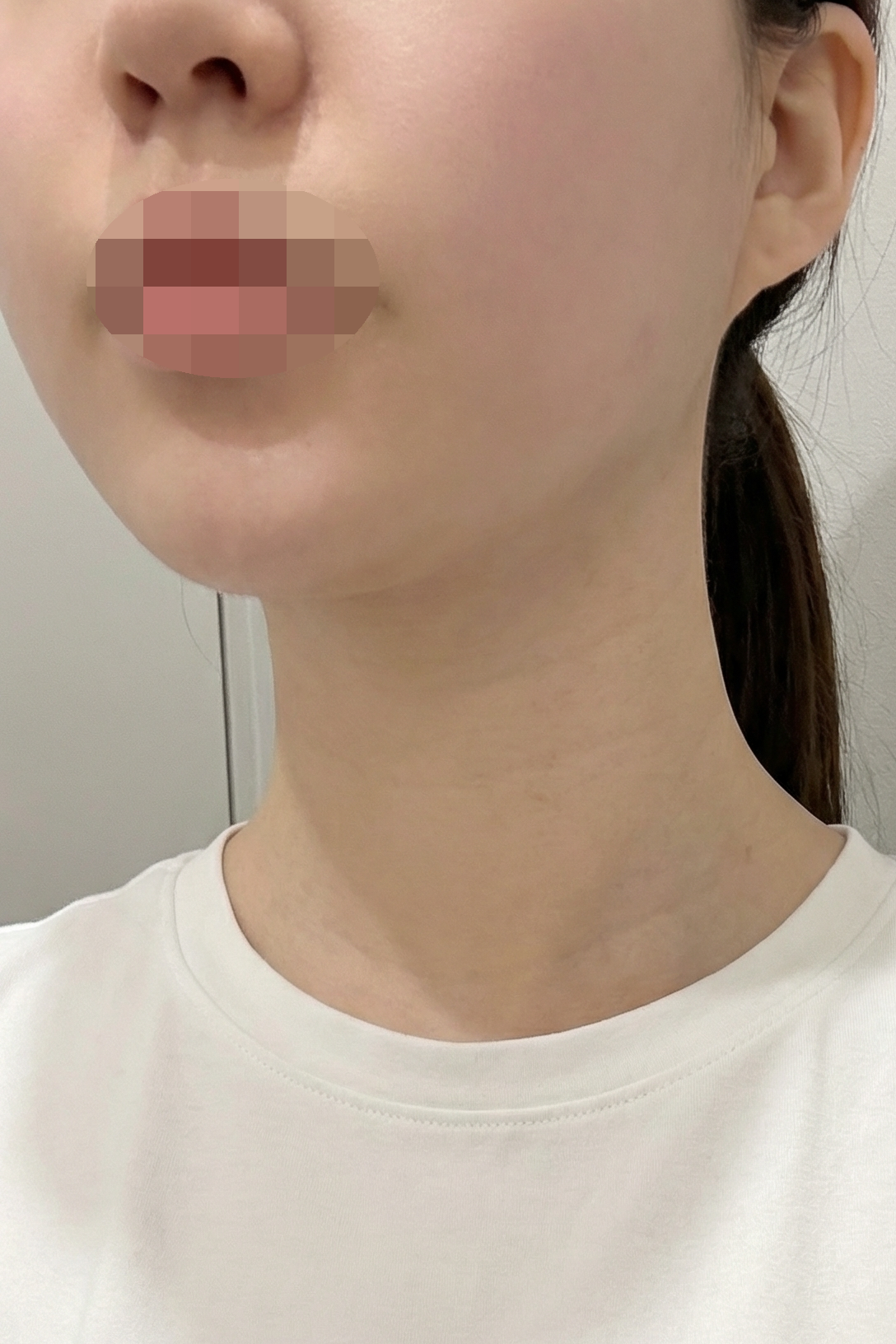 수술후기이미지