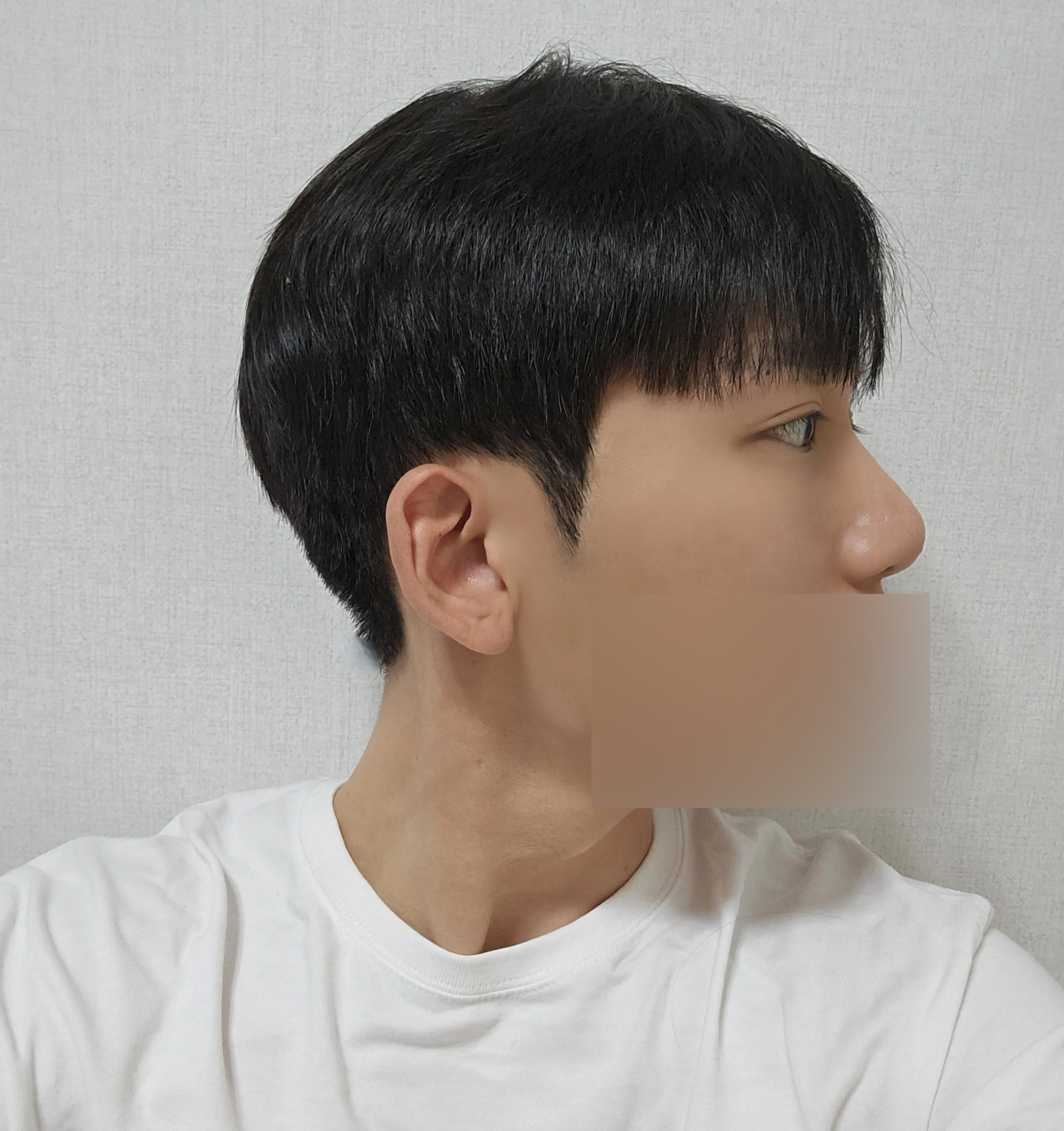 남자 눈·코 수술 3개월차, 자연스럽게 자리 잡는 중입니다