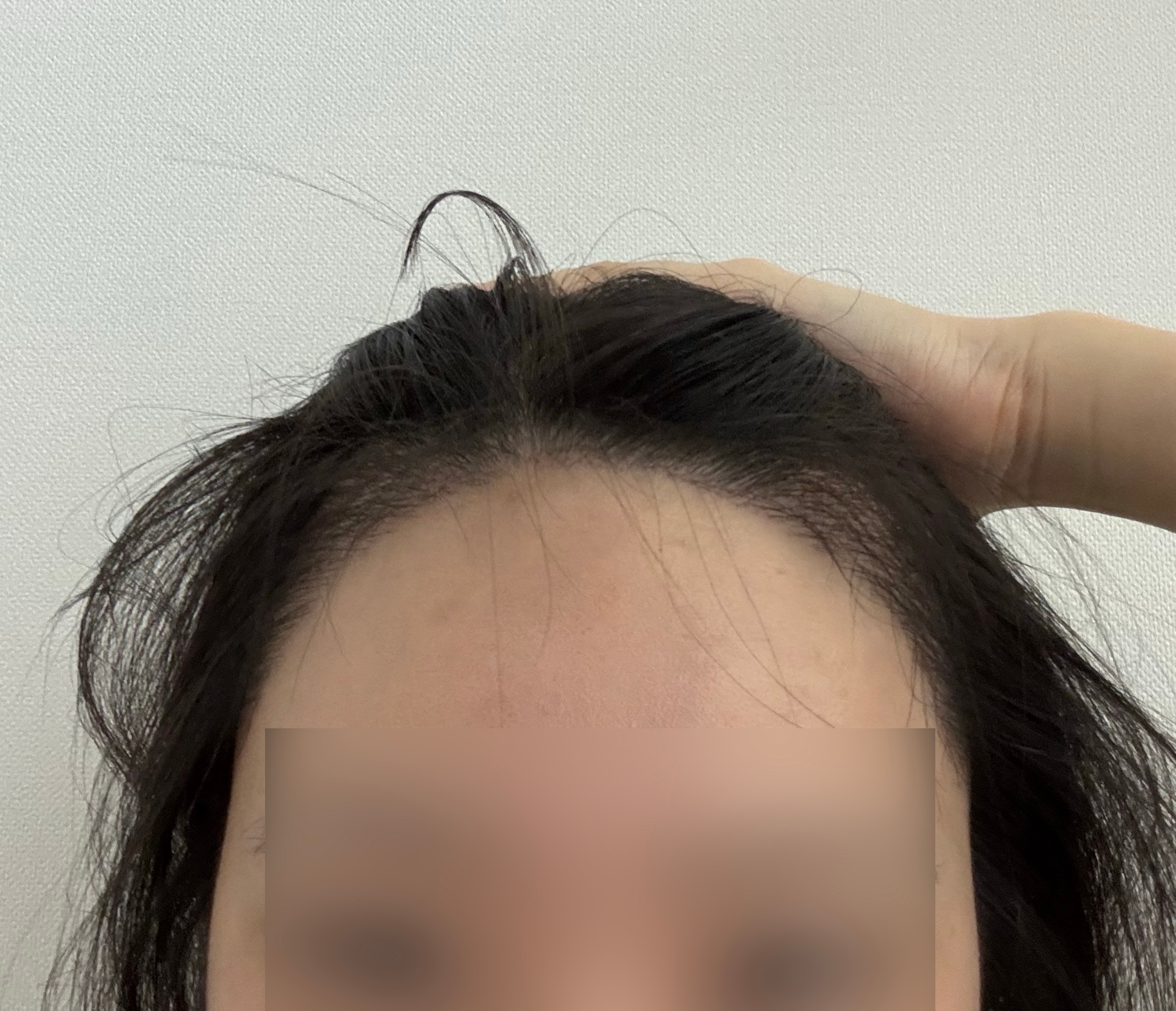 절개 모발이식 4개월차, 점점 풍성해지는 변화!