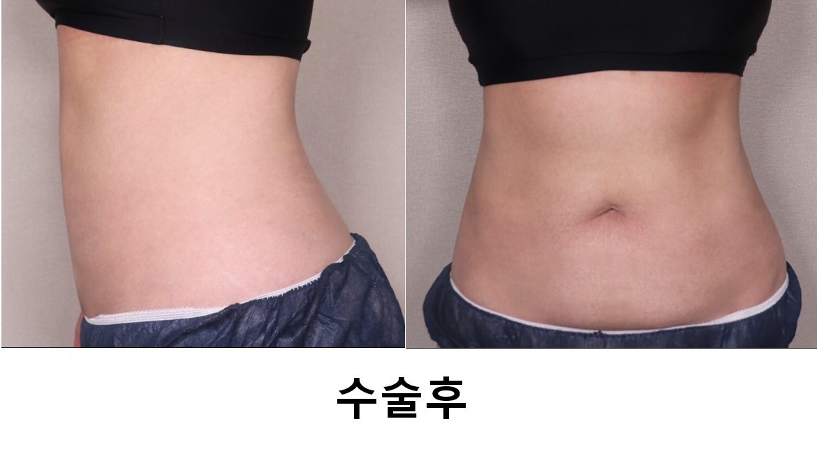 복부지방흡입 3개월차후기입니다