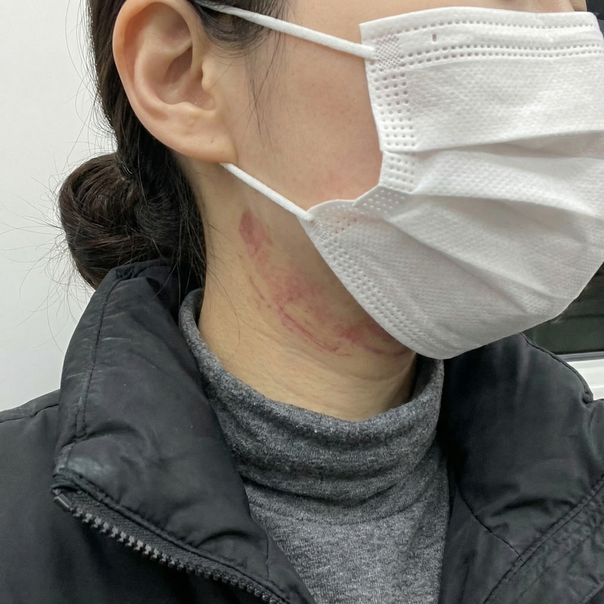 수술후기이미지