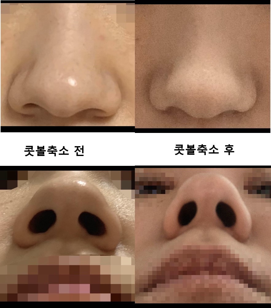 수술후기이미지